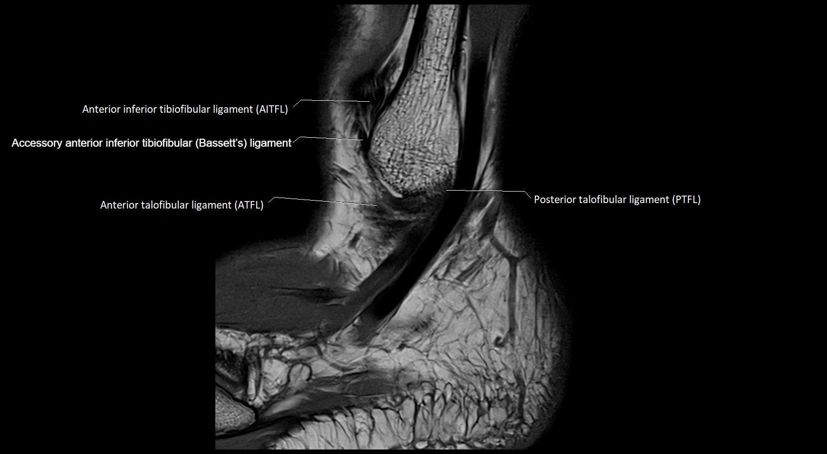 MRI ankle ligaments anatomy sagittal 3T image 25.webp